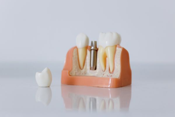 implantes-dentales-boadilla-del-monte-implantemuela
