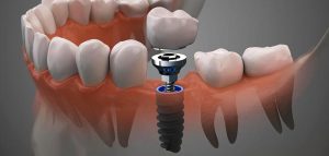 implantologia dental