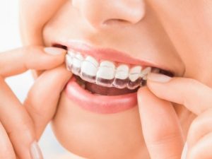ortodoncia invisible