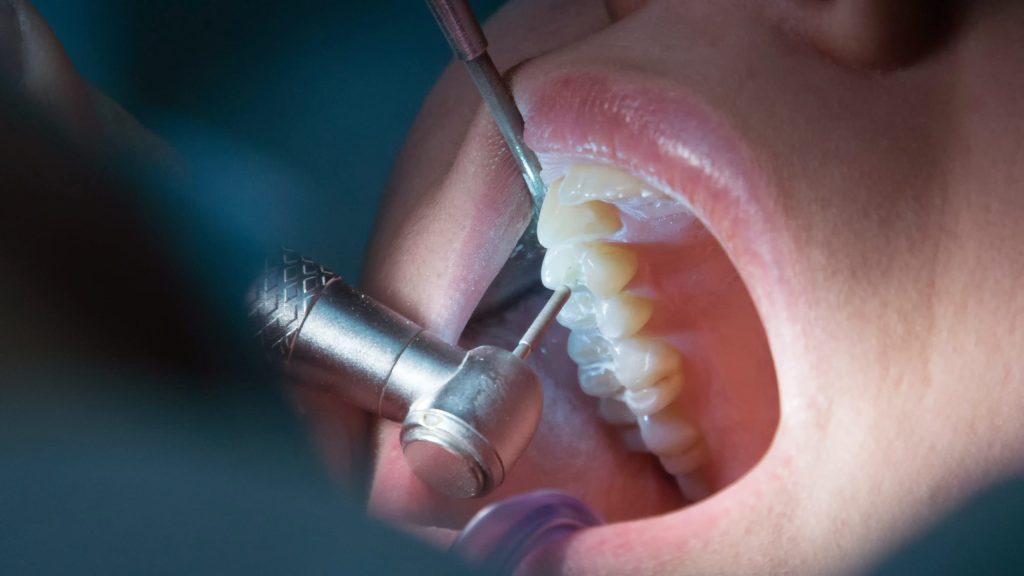 Endodoncia