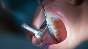Endodoncia