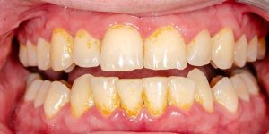 Sarro en los dientes