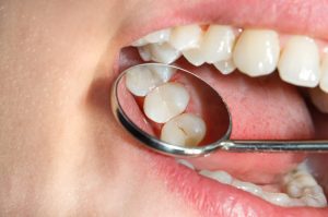 tipos-de-caries