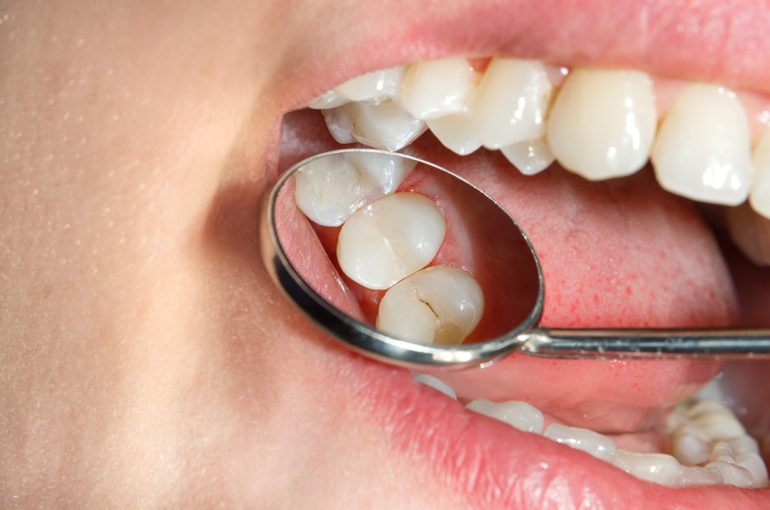 tipos-de-caries