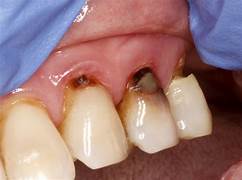 Caries radiculares
