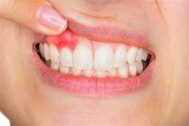 Gingivitis descamativa