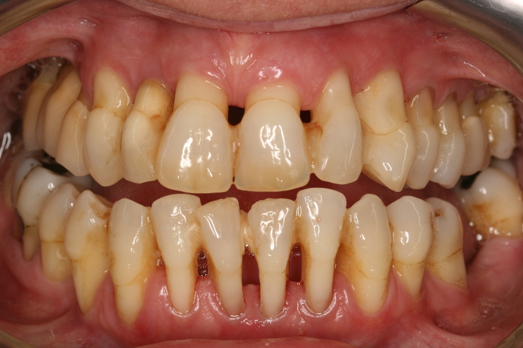 Periodontitis y pérdida de hueso