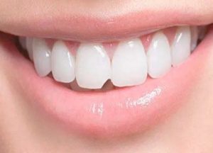 microfracturas dentales