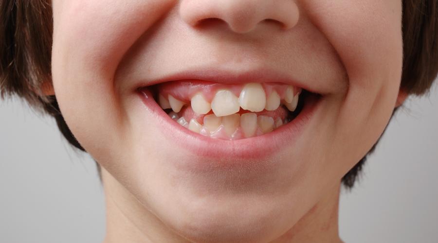 Dientes torcidos o mal alineados