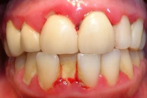 Enfermedades de las encías