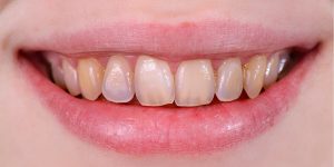 Erosión del esmalte