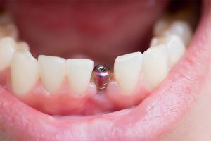 implantes dentales