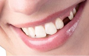 Cómo prevenir la pérdida de dientes