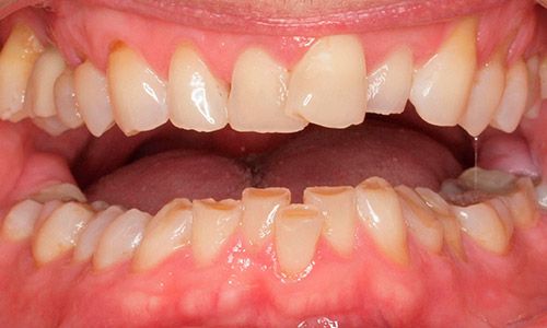 dientes-desgastados