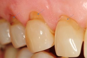 Dientes sensibles: causas y tratamiento