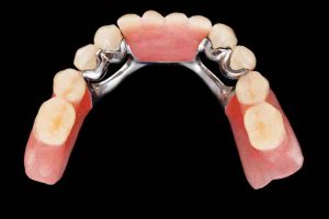 Puente dental