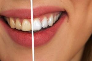 blanqueamiento-dental-embajadores-sonrisa