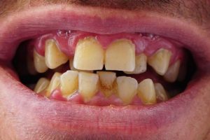 periodoncia-embajadores-dientesmalos
